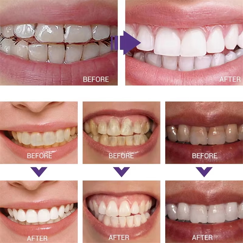 Pasta de Dente Clareadora e Ge - Teeth Whitening In Korea avaliação e preço