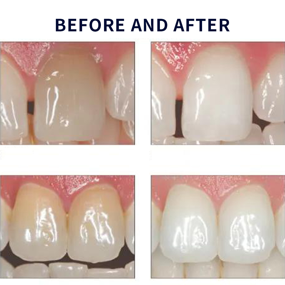 Opalescência Whitening Gel Kit - Teeth Whitening Remedies avaliação e preço