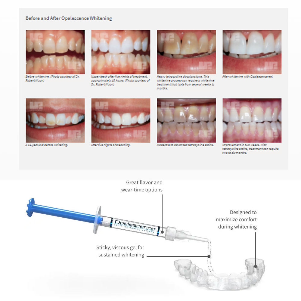 Opalescência Whitening Gel Kit - Teeth Whitening Remedies avaliação e preço