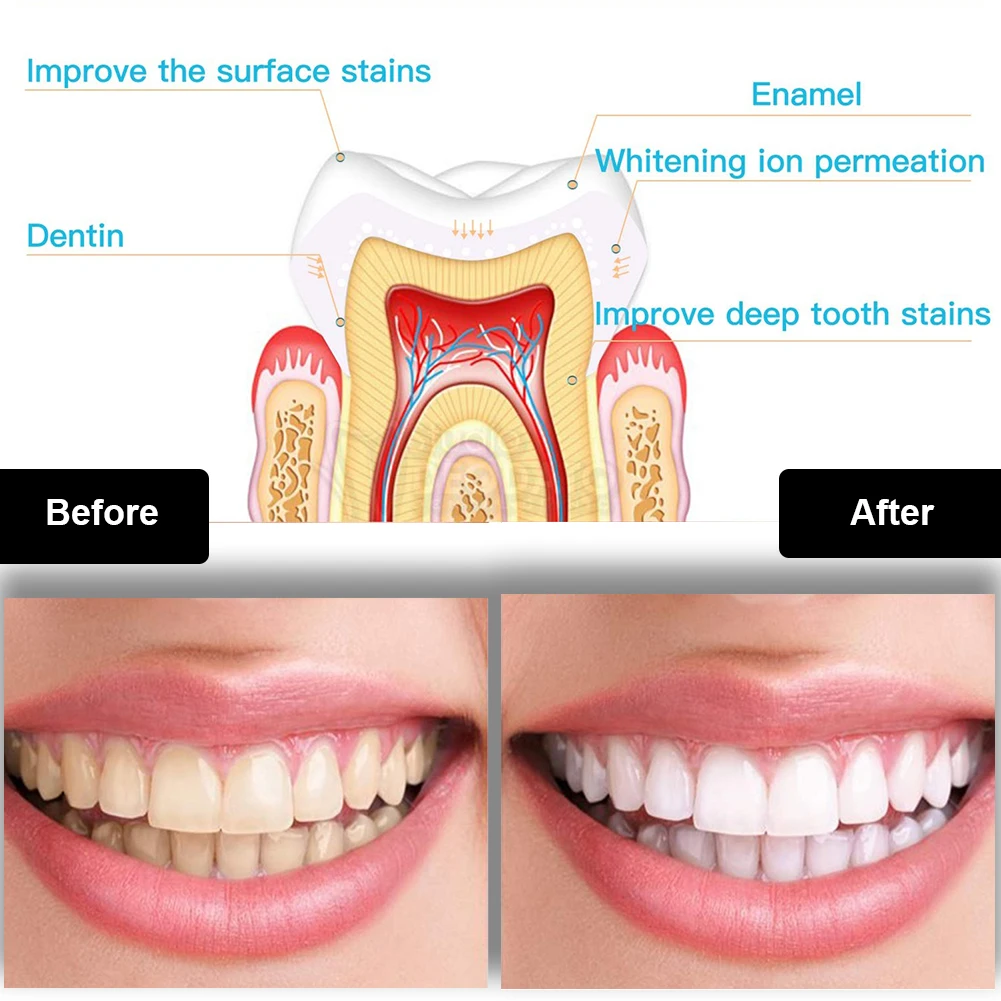 Kit de clareamento dental dos  - Teeth Whitening Gel Pen avaliação e preço
